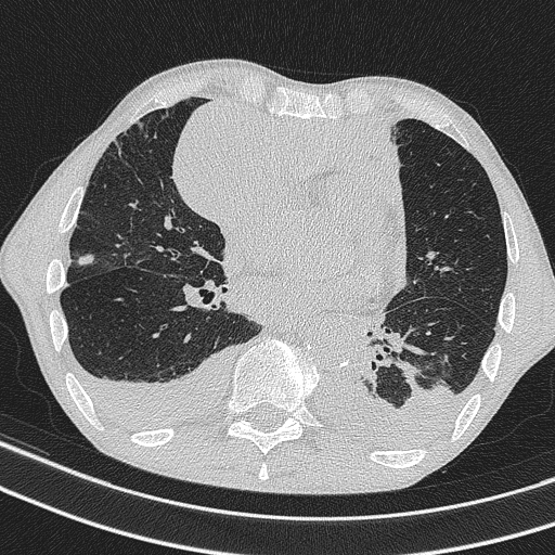Central venous catheter tip extravasation (Radiopaedia 82828-97113 Axial lung window 52).jpg