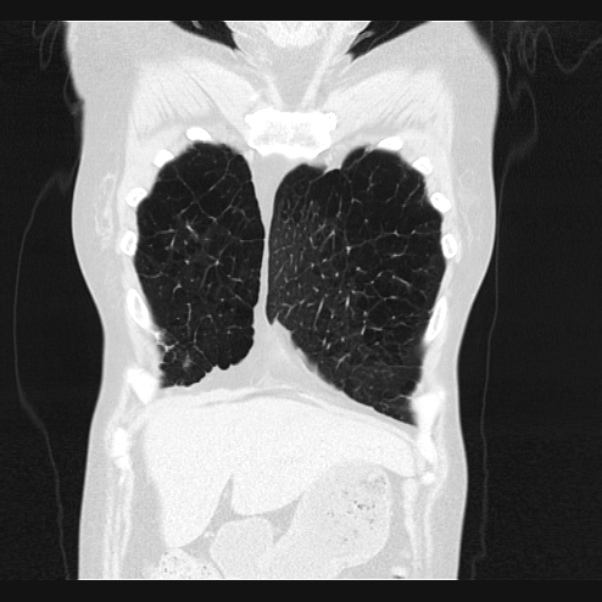 Centrilobular pulmonary emphysema (Radiopaedia 24495-24789 Coronal lung window 10).jpg