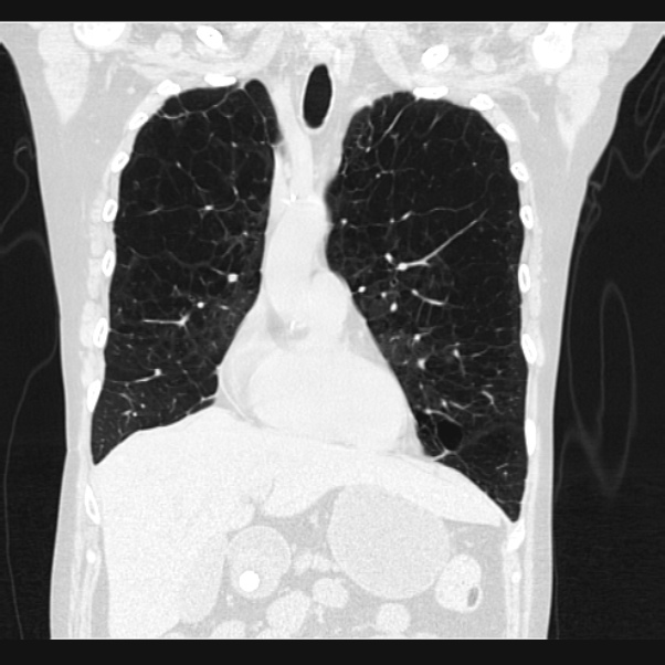 Centrilobular pulmonary emphysema (Radiopaedia 24495-24789 Coronal lung window 24).jpg