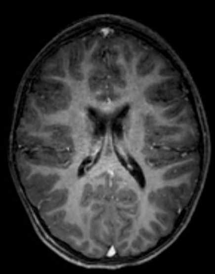 Cerebellar abscess (Radiopaedia 73727-84563 Axial T1 C+ fat sat 72).jpg