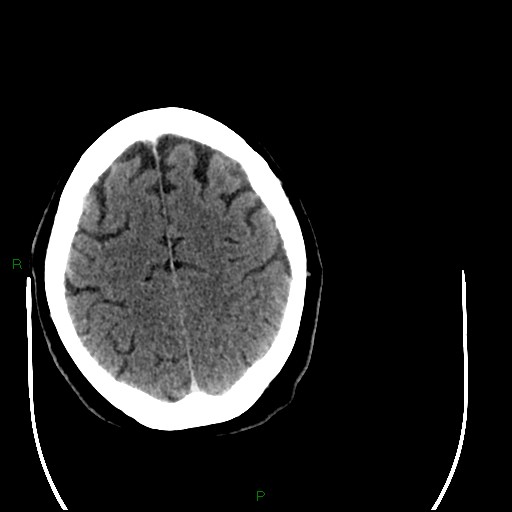 Cerebellar abscess (Radiopaedia 78135-90671 Axial C+ delayed 85).jpg
