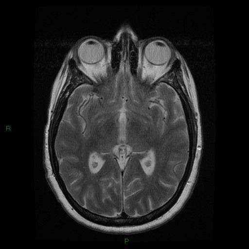 File:Cerebellar abscess (Radiopaedia 78135-90678 Axial T2 15).jpg