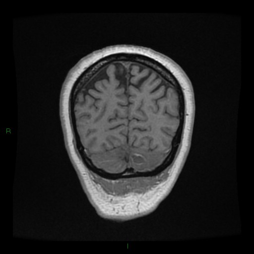 File:Cerebellar abscess (Radiopaedia 78135-90678 Coronal T1 C+ 142).jpg