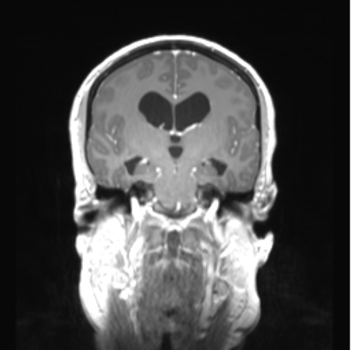 Cerebellar ependymoma complicated by post-operative subdural hematoma (Radiopaedia 83322-97736 Coronal T1 C+ 28).png