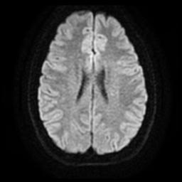 Cerebellar hemangioblastoma (Radiopaedia 29570-30077 Axial DWI 17).jpg