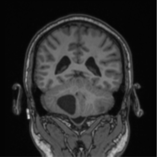 File:Cerebellar hemangioblastomas and pituitary adenoma (Radiopaedia 85490-101176 Coronal T1 35).png