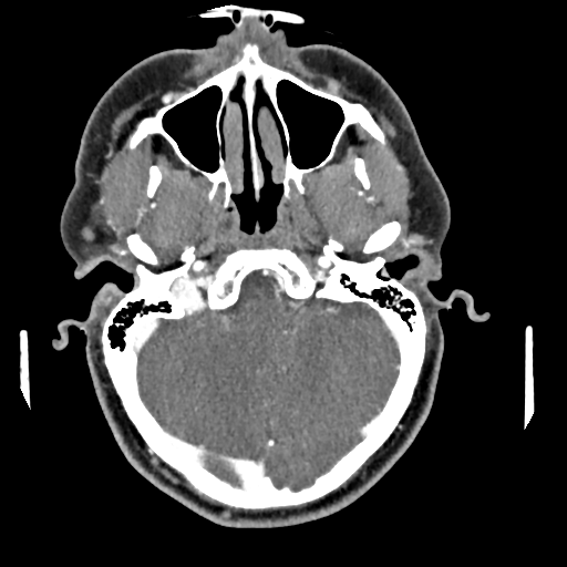 Cerebellar infarct due to vertebral artery dissection with posterior fossa decompression (Radiopaedia 82779-97029 C 27).png