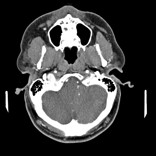 Cerebellar infarct due to vertebral artery dissection with posterior fossa decompression (Radiopaedia 82779-97029 C 36).png