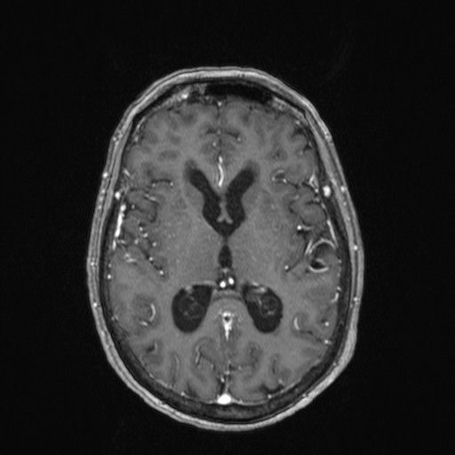 Cerebellar metastases (Radiopaedia 24038-24249 Axial T1 C+ 12).jpg