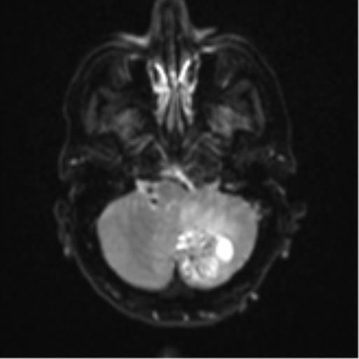 Cerebellar metastasis (Radiopaedia 51137-56765 Axial DWI 6).png