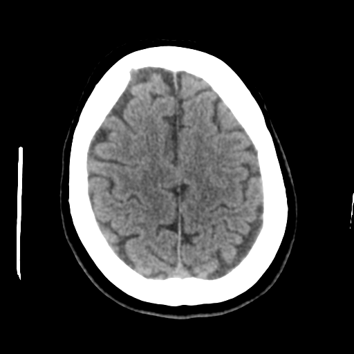 Cerebellar metastasis (cystic appearance) (Radiopaedia 41395-44258 Axial non-contrast 42).png
