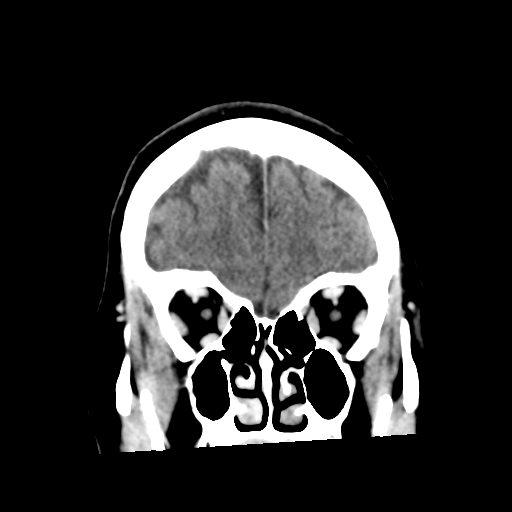 Cerebellar metastasis (cystic appearance) (Radiopaedia 41395-44258 D 16).png