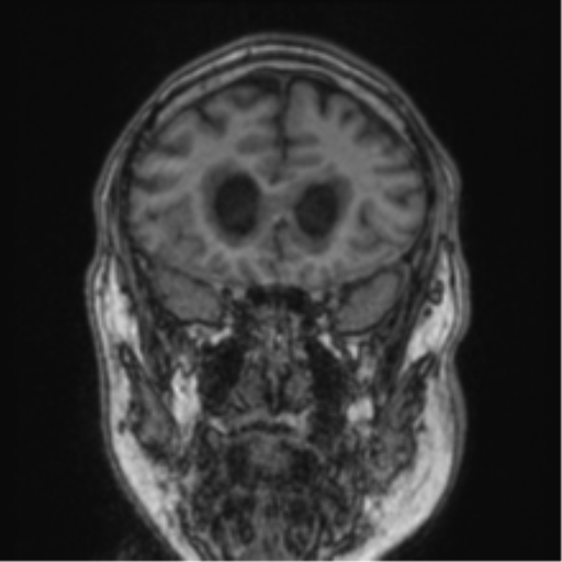 File:Cerebellar metastasis from lung adenocarcinoma (Radiopaedia 86690-102829 Coronal T1 72).png