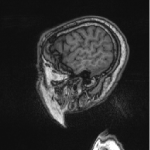 Cerebellar metastasis from lung adenocarcinoma (Radiopaedia 86690-102829 Sagittal T1 23).png