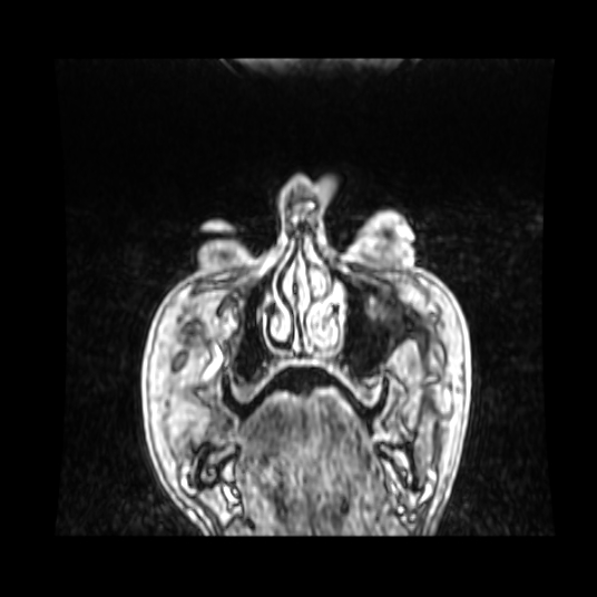 File:Cerebellar metastasis of pulmonary adenocarcinoma, cavernous venous malformation, and developmental venous anomaly (Radiopaedia 85827-101661 Coronal T1 C+ 92).jpg