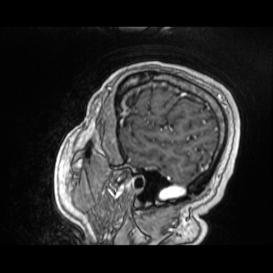 Cerebellar metastasis of pulmonary adenocarcinoma, cavernous venous malformation, and developmental venous anomaly (Radiopaedia 85827-101661 Sagittal T1 C+ 20).jpg