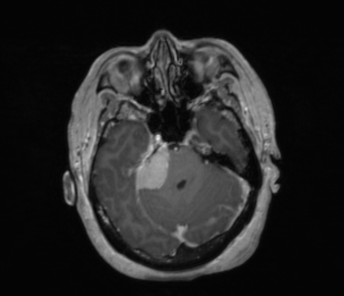 Cerebellopontine angle meningioma (Radiopaedia 35181-36715 Axial T1 C+ 39).jpg
