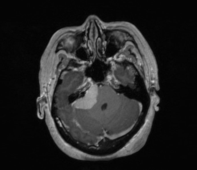 Cerebellopontine angle meningioma (Radiopaedia 35181-36715 Axial T1 C+ 40).jpg