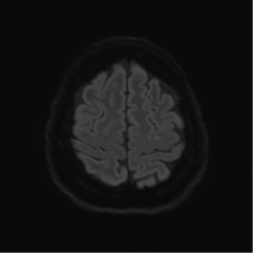 Cerebellopontine angle meningioma (Radiopaedia 48434-53348 Axial DWI 69).png
