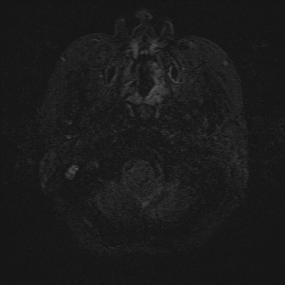 Cerebellopontine angle meningioma (Radiopaedia 53561-59591 Axial 3D volume T2 2).jpg