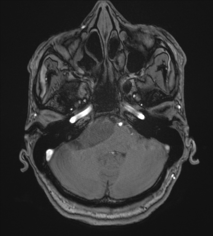 Cerebellopontine angle meningioma (Radiopaedia 72983-83680 Axial MRA 21).jpg