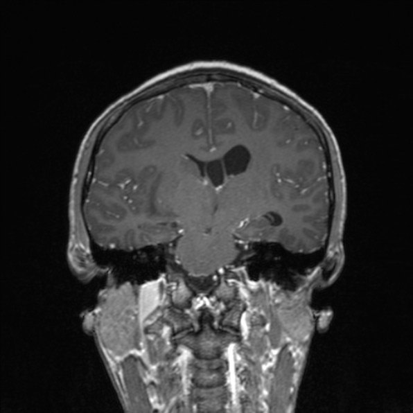 Cerebral abscess (Radiopaedia 24212-24478 Coronal T1 C+ 118).jpg