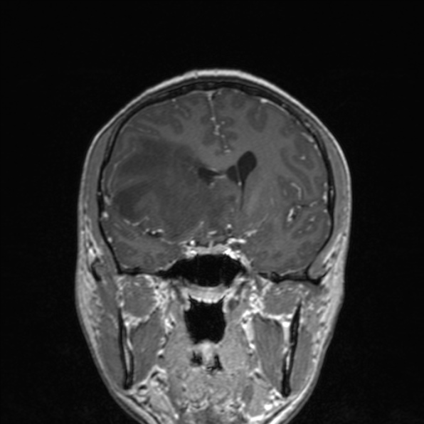 File:Cerebral abscess (Radiopaedia 24212-24478 Coronal T1 C+ 94).jpg