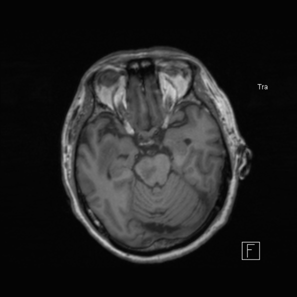 Cerebral abscess (Radiopaedia 26111-26247 Axial T1 26).jpg