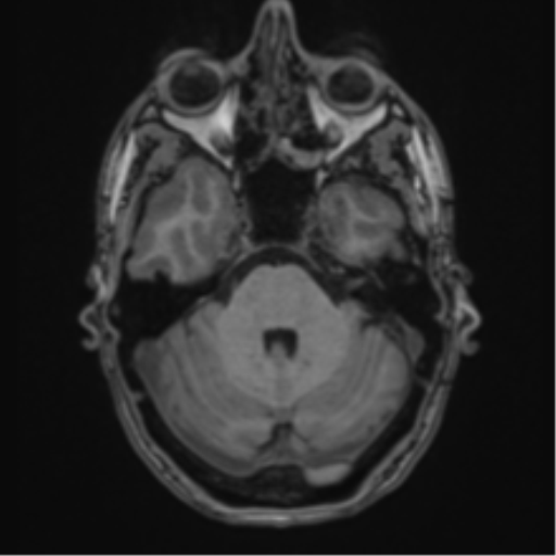 File:Cerebral abscess (Radiopaedia 60342-68009 Axial T1 10).png