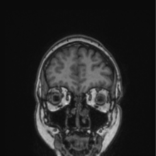 File:Cerebral abscess from pulmonary arteriovenous malformation (Radiopaedia 86275-102291 Coronal T1 74).png