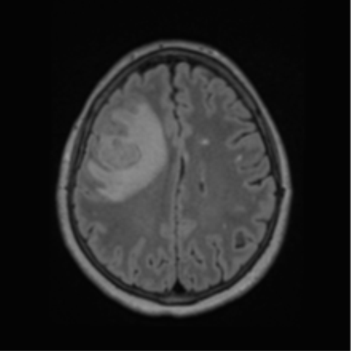 Cerebral abscess from pulmonary arteriovenous malformation (Radiopaedia 86275-102291 J 51).png