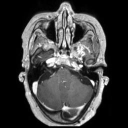 Cerebral amyloid angiopathy (Radiopaedia 29129-29518 Axial T1 C+ 38).jpg