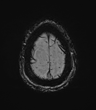 Cerebral amyloid angiopathy (Radiopaedia 46082-50433 Axial SWI 79).png