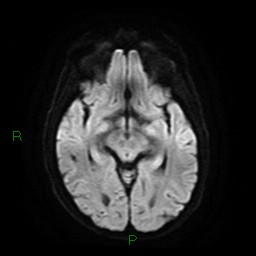 Cerebral amyloid angiopathy (Radiopaedia 77506-89664 Axial DWI 13).jpg
