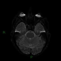 Cerebral amyloid angiopathy (Radiopaedia 77506-89664 Axial DWI 38).jpg