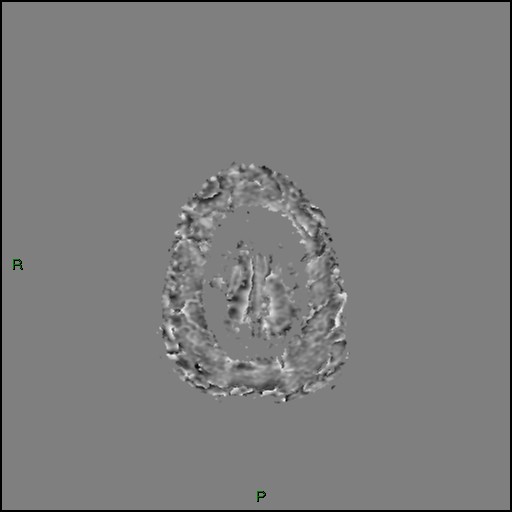 Cerebral amyloid angiopathy (Radiopaedia 77506-89664 H 99).jpg