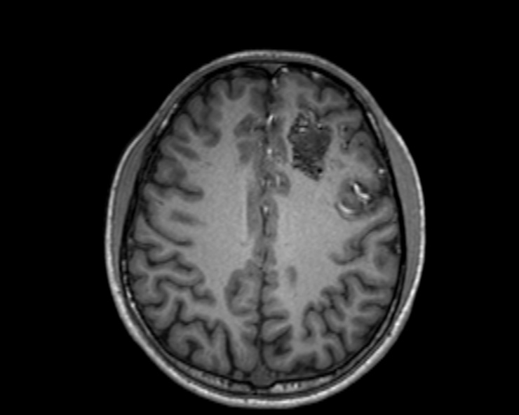 Cerebral arteriovenous malformation (Radiopaedia 30198-30813 Axial T1 25).jpg