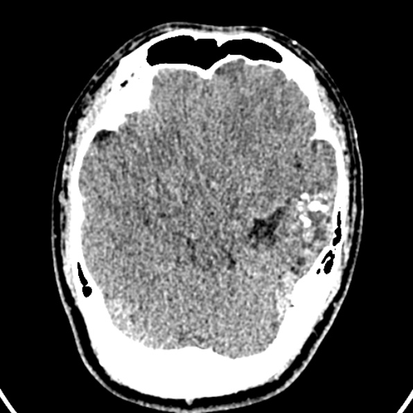 Cerebral arteriovenous malformation (Radiopaedia 37182-39012 Axial non-contrast 19).jpg