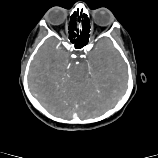 Cerebral arteriovenous malformation (Radiopaedia 73830-84645 B 65).jpg