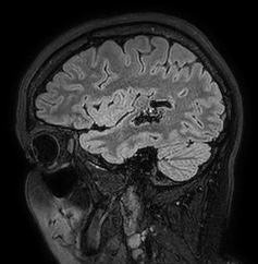 Cerebral arteriovenous malformation (Radiopaedia 74411-85654 Sagittal FLAIR 29).jpg