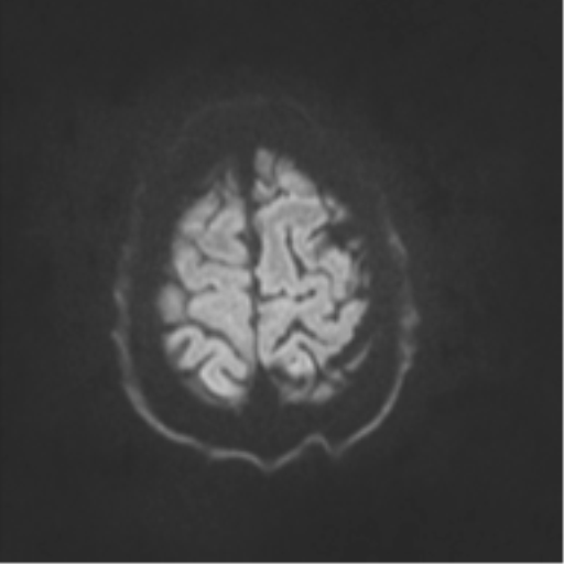 File:Cerebral arteriovenous malformation - huge (Radiopaedia 35734-37272 Axial DWI 44).png