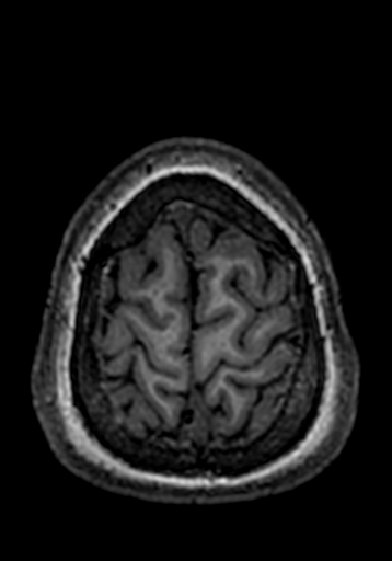 Cerebral arteriovenous malformation at posterior body of corpus callosum (Radiopaedia 74111-84925 Axial T1 17).jpg