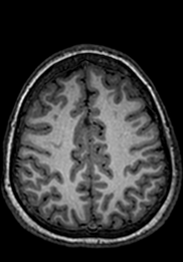 Cerebral arteriovenous malformation at posterior body of corpus callosum (Radiopaedia 74111-84925 Axial T1 68).jpg