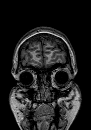 Cerebral arteriovenous malformation at posterior body of corpus callosum (Radiopaedia 74111-84925 Coronal T1 8).jpg