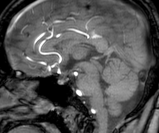 Cerebral arteriovenous malformation at posterior body of corpus callosum (Radiopaedia 74111-84925 J 196).jpg