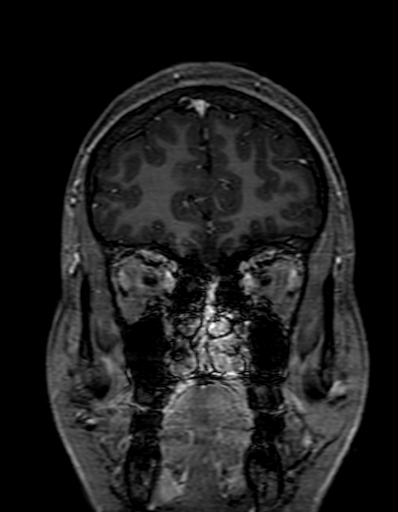 Cerebral arteriovenous malformation at posterior body of corpus callosum (Radiopaedia 74111-84925 K 57).jpg