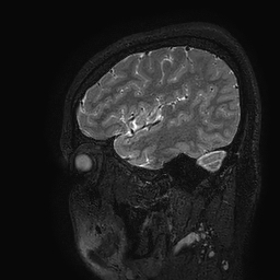 Cerebral arteriovenous malformation at posterior body of corpus callosum (Radiopaedia 74111-84925 Sagittal T2 112).jpg