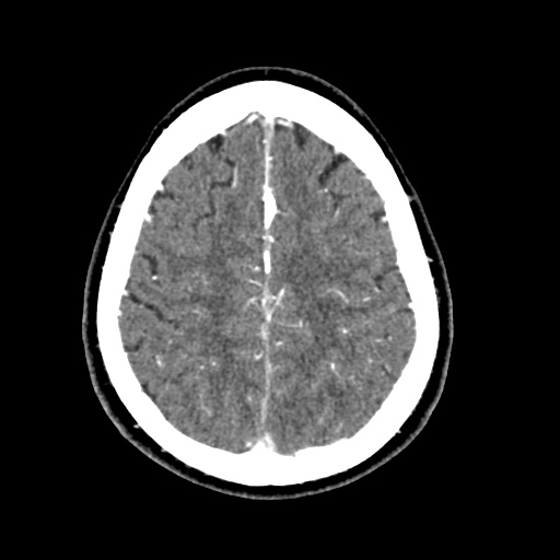 Cerebral arteriovenous malformation with lobar hemorrhage (Radiopaedia 35598-57216 A 49).jpg