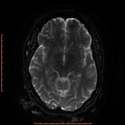 File:Cerebral cavernous malformation (Radiopaedia 26177-26306 Axial DWI 30).jpg