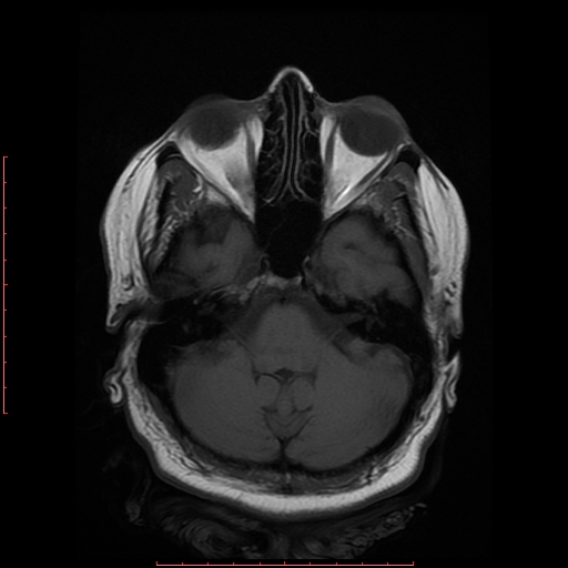 File:Cerebral cavernous malformation (Radiopaedia 26177-26306 Axial T1 6).jpg